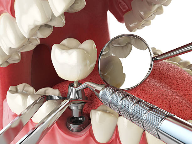 Best Knocked-Out Tooth (Avulsed Tooth) Treatment in Indian Shores, FL